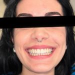 TONI Landing Foto Invisaling Pazienti